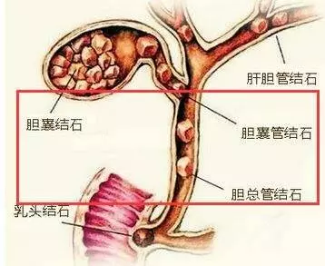 7天內能排出體內幾十顆「膽結石」!每個人都有!嘗試後整個人神清氣爽!