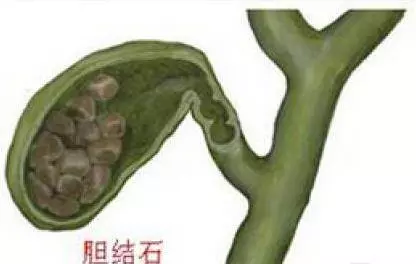 7天內能排出體內幾十顆「膽結石」!每個人都有!嘗試後整個人神清氣爽!