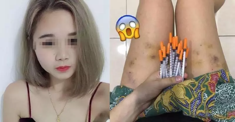 【媽媽真的太偉大了!】大馬辣媽爆「剖腹產」後需要『打超過20支針』!打到雙腿都是瘀青~