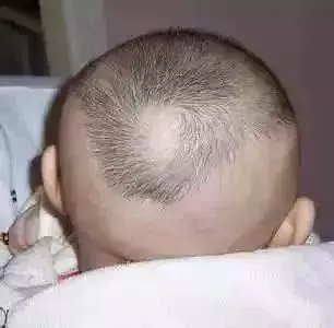 1歲寶寶腎里長滿石頭,兒科醫生厲聲訓斥!只因奶奶錯誤的愛