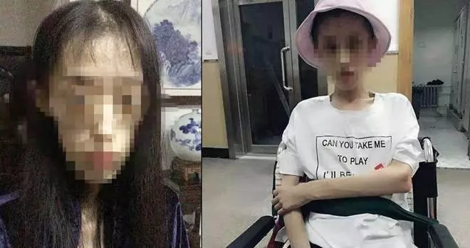 21歲女愛美自殺式減肥 ,腦組織退化有如60歲老人