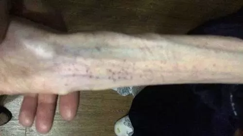 21歲女愛美自殺式減肥 ,腦組織退化有如60歲老人