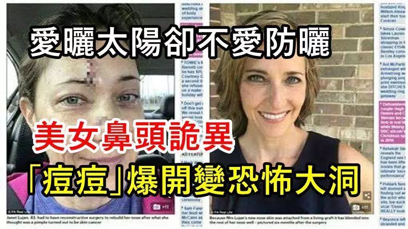 愛曬太陽卻不愛防曬,美女鼻頭詭異「痘痘」爆開變恐怖大洞