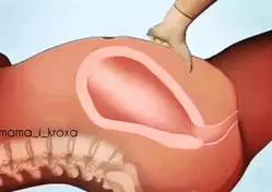 生孩子的疼算什麼?更痛的是刮胎盤的疼!疼到我想放棄生命!看過這組動圖你就明白了!!