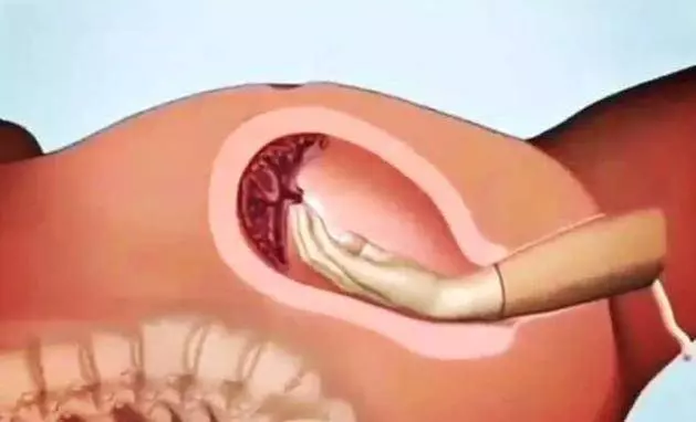 生孩子的疼算什麼?更痛的是刮胎盤的疼!疼到我想放棄生命!看過這組動圖你就明白了!!