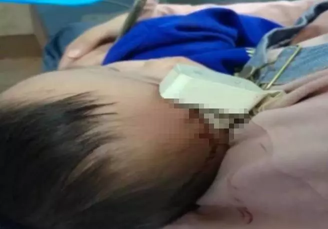 2歲男童滾下床「充電器插進額頭」 爸媽驚見2個洞!