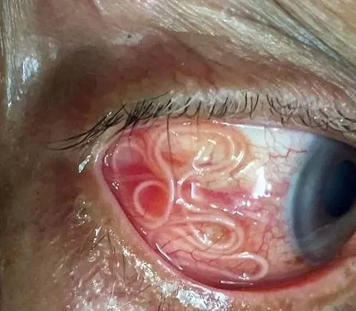 印度老翁眼球藏15公分寄生蟲
