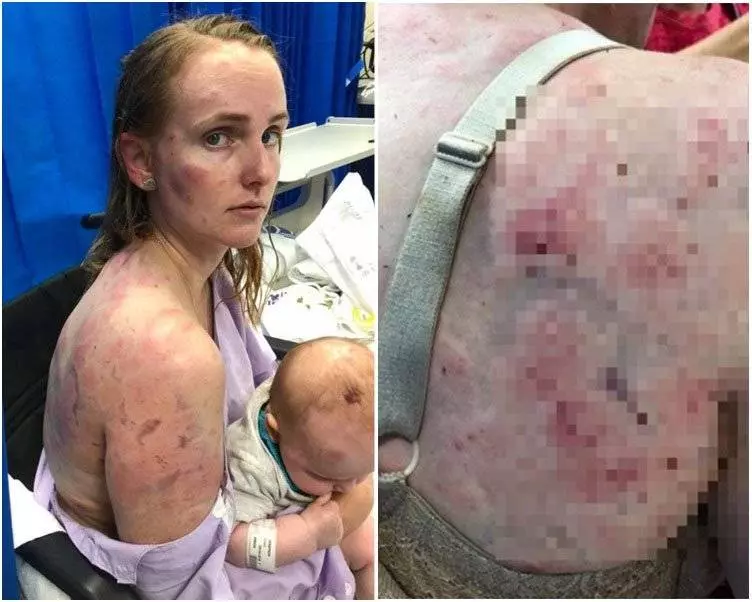 駕車冰雹來襲 慈母肉身護女致遍體麟傷 |