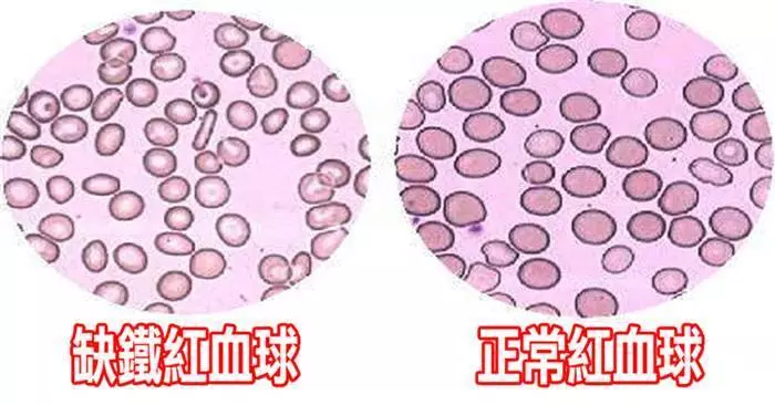 他睡覺總覺得「雙腿有螞蟻在爬」掀開棉被卻都沒看到,去醫院才發現他罹患了...嚇到雙腿發軟!