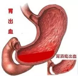 新加坡工作壓力大,男子勞累過度致吐血猝死,臨終說:「好累......」用健康換金錢?值得嗎.....