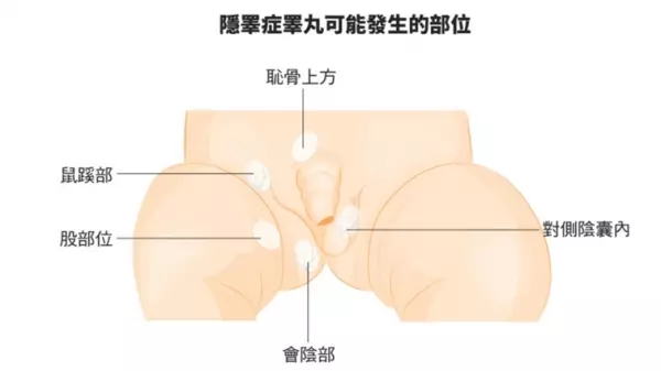 手殘醫「裝錯邊」!隱睪症變...2歲男童從此變公公!媽媽崩潰:人生全毀