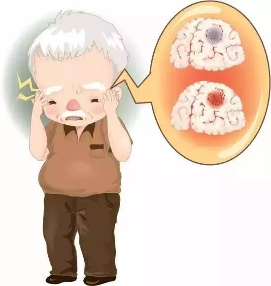 容易患上【腦中風】的10種人,身上會有4種訊號,知道了能救命 !!