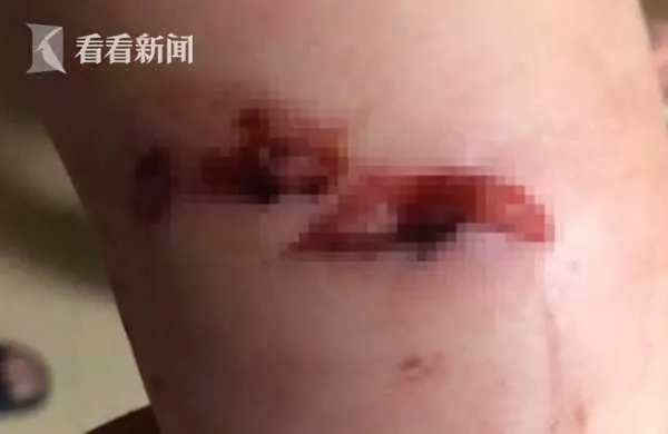 9個月女嬰,遭惡犬撲咬滿腿是血狗主人拖欠賠償還稱:狗已賣掉!
