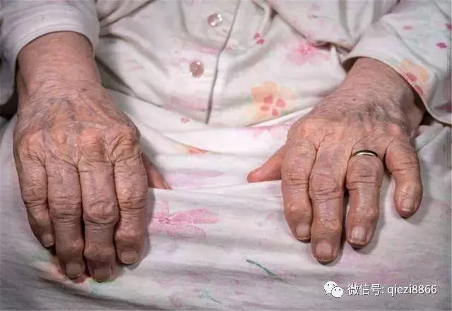 不想痛風纏上身,3種食物儘量少吃,痛風慢慢「離你而去」