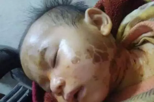 1歲小孩臉部燙傷80%,只用了這個東西!臉竟然完全好了!醫生都不知道的,一定要分享,能幫助更多的人
