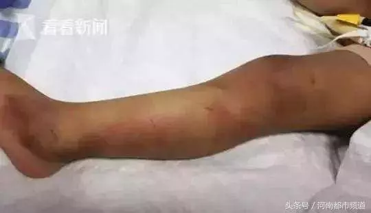 心痛!1歲女童疑遭母親男友虐待,生還可能為零!嫌疑人被刑拘!
