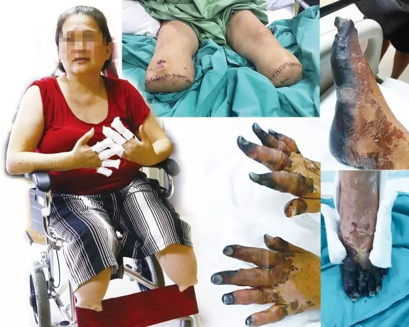 「醫生害我沒手腳」 剩下兩隻發黑的手指等待自然脫落,而其餘手指已經無法操作