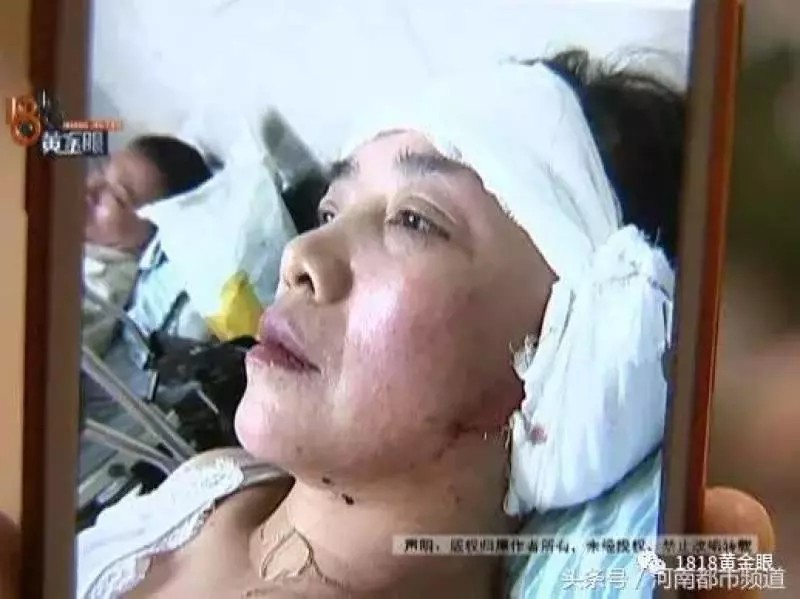 杭州女子逛街耳朵差點被砸掉縫了16針,感音神經性聾,咋賠?