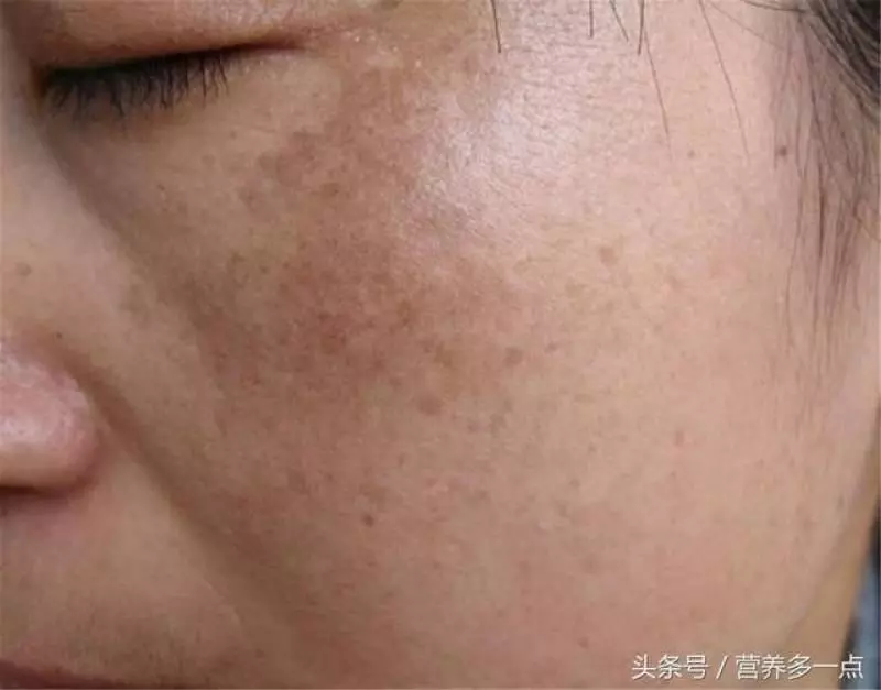 皮膚長斑很難看?用桑葉煮水去雜質,臉上斑點悄悄減少