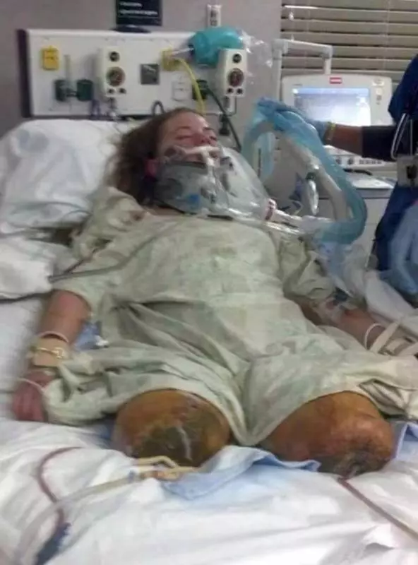 女遭下藥撿屍被丟鐵軌輾斷腿 仍不放棄人生