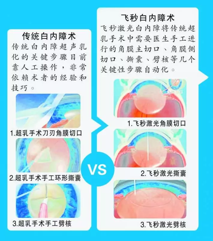 無刀白內障手術 ...
