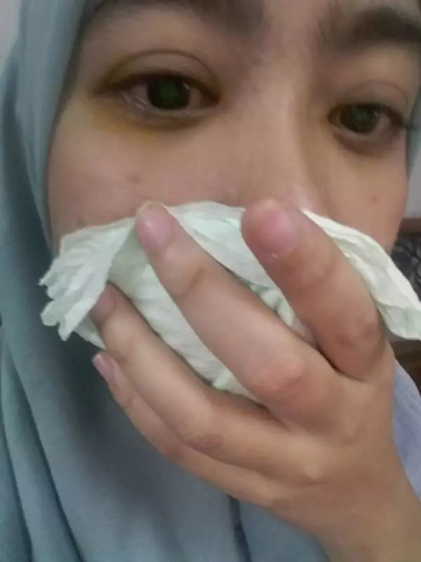 馬來女子戴隱形眼鏡僅1天,「眼睛刺痛、模糊不清」,差點失明