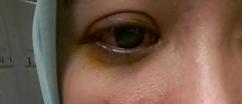 馬來女子戴隱形眼鏡僅1天,「眼睛刺痛、模糊不清」,差點失明