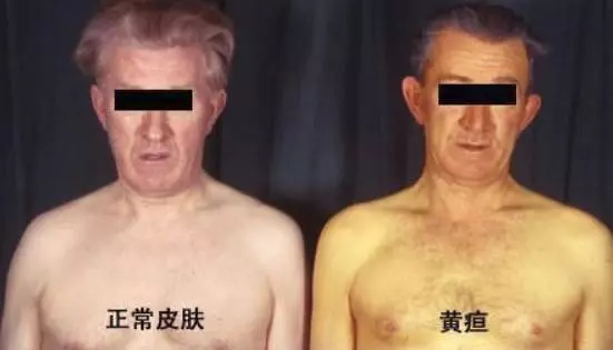 肝不好先看臉,臉上一旦出現這2種情況,警示你肝毒太多