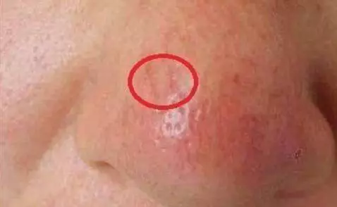 肝不好先看臉,臉上一旦出現這2種情況,警示你肝毒太多