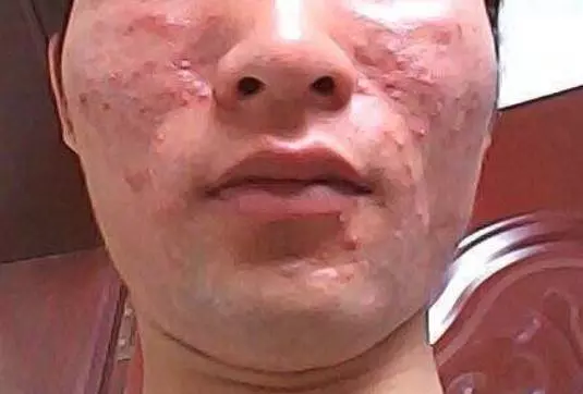 肝不好先看臉,臉上一旦出現這2種情況,警示你肝毒太多