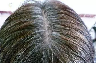 年輕就長滿白髮?教你這樣吃,有助於長黑髮