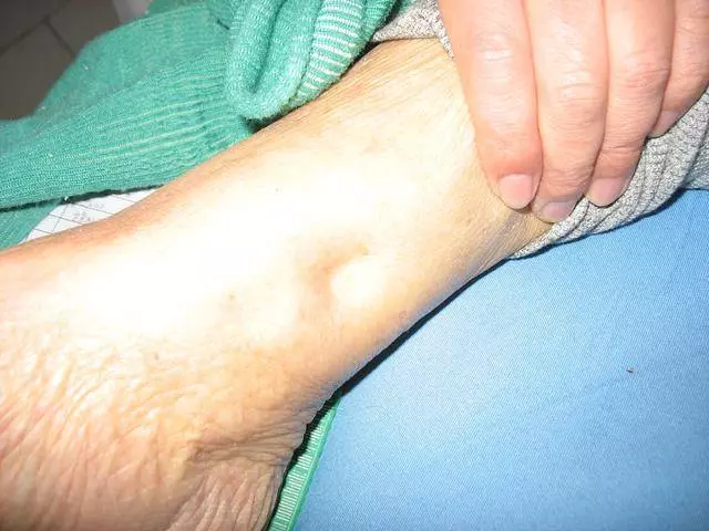 身體出現5大症狀,說明你的血管已經堵塞了,趕緊自查一下