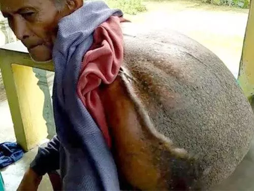 憂沒錢不看病 小肉塊40年後重5kg