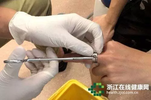 男子被戒指卡住 竟然找牙醫求救