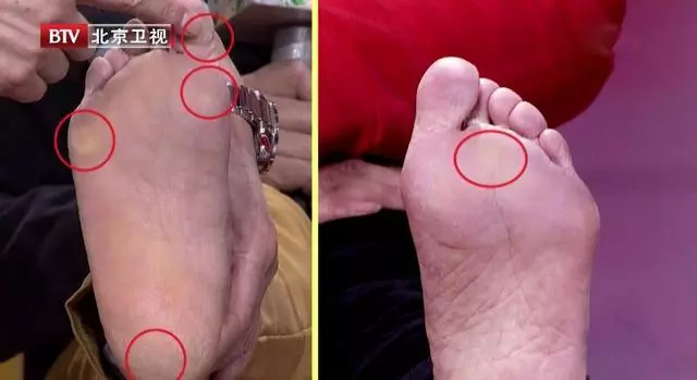 腳後跟痛、腳底長繭是病!簡單幾招,不用花錢,趕走疼痛