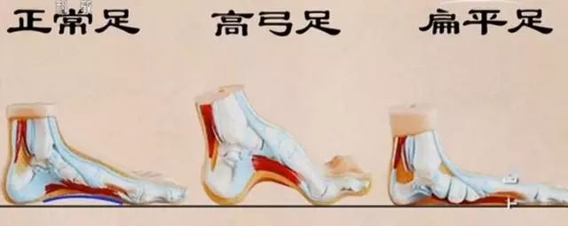 腳後跟痛、腳底長繭是病!簡單幾招,不用花錢,趕走疼痛