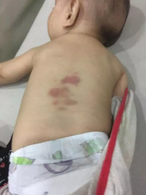 又是保母虐嬰 男嬰眼紅腫 背瘀青