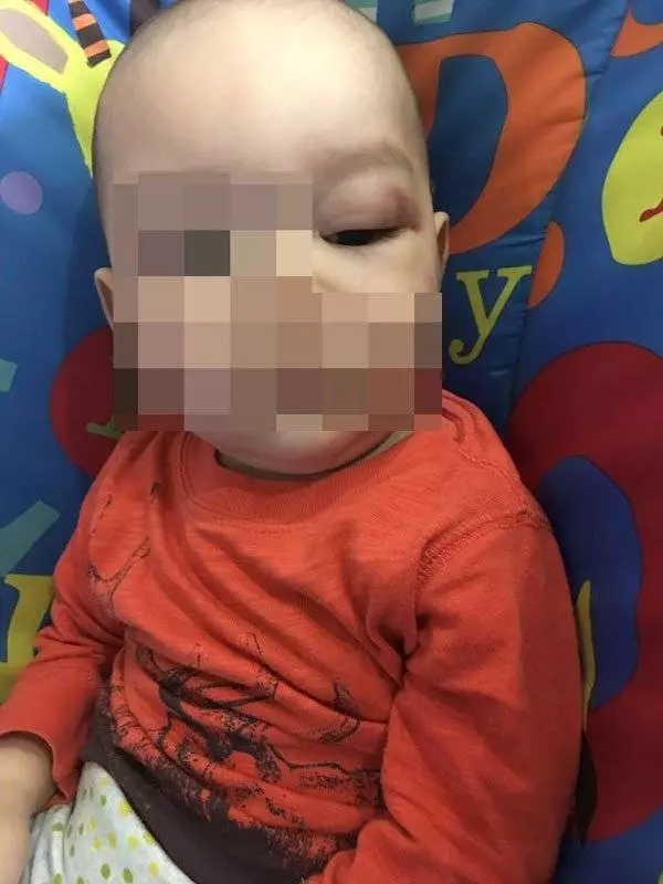 又是保母虐嬰 男嬰眼紅腫 背瘀青