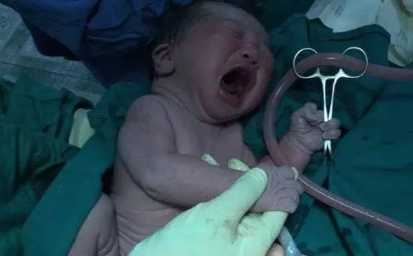 初生男嬰手拿剪 醫生快手留珍貴瞬間
