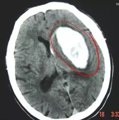 為何「中風」越來越多?奉勸你,這3樣食物會「加速」血管堵塞