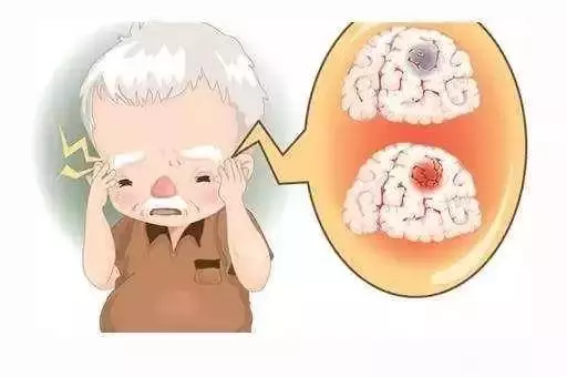 心梗、腦梗、腦出血救命的【黃金5分鐘】,關鍵時刻能保命