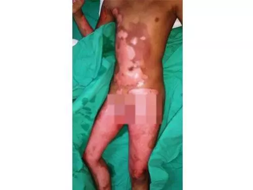 實驗室打翻熱水壼 4學生被燙傷