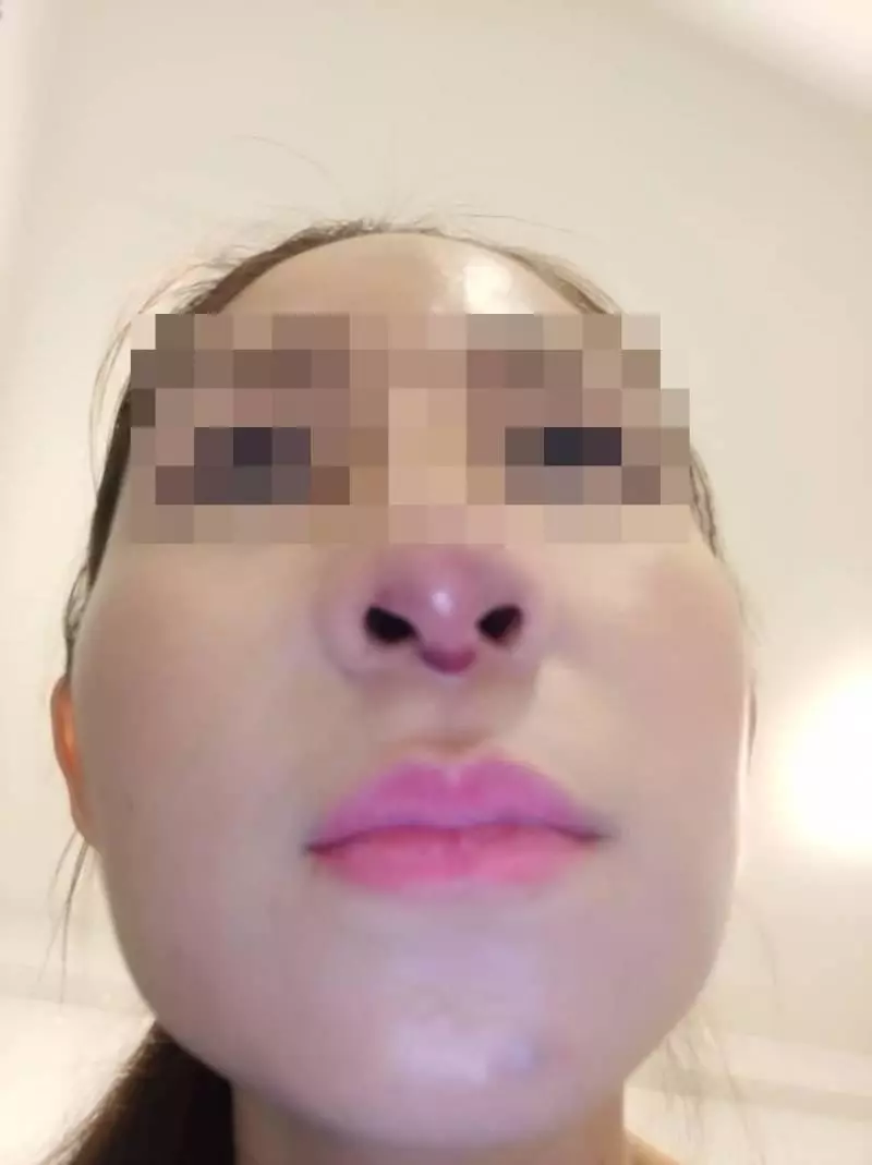 誤信無牌醫生 女子挨刀隆鼻 失敗