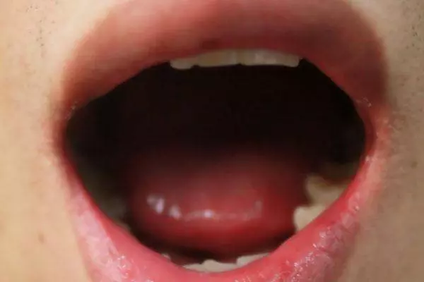 血糖高不高?看舌頭就知道,出現這3種症狀,可能是血糖升高了