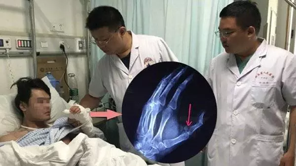可樂墜地變「炸彈」 男子手指被炸到骨折