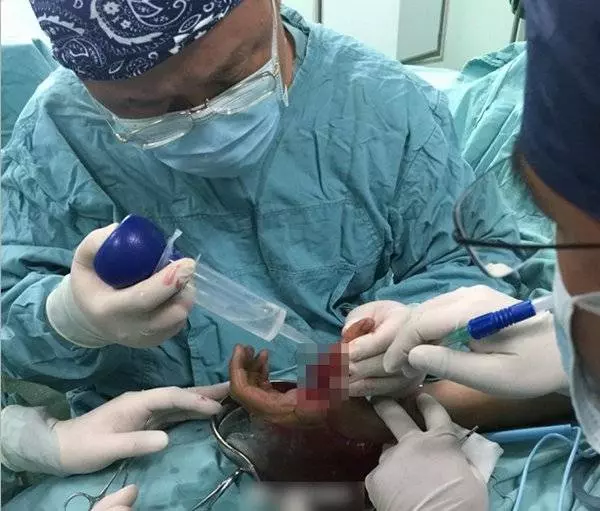 可樂墜地變「炸彈」 男子手指被炸到骨折