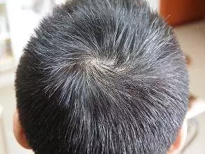 白髮別急著染,用幾塊錢的小偏方就能根治