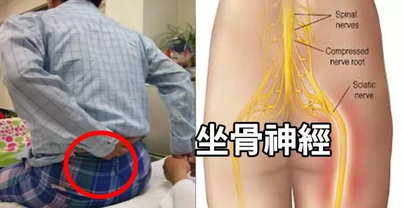 消滅「坐骨神經痛」不必挨刀每天30秒「躺著拉筋」讓「腰椎」年齡回春20