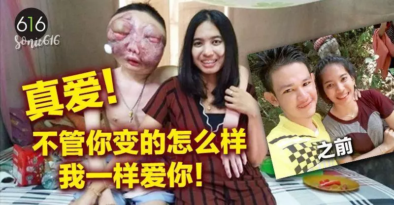 男子患癌臉部變形 女友伴3年不離不棄【視頻】