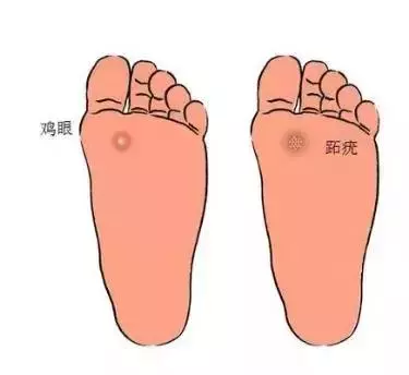 雞眼、蹠疣,傻傻分不清,七招教您正確區分!